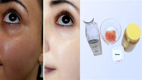 Skin Whitening Home Remedies Live Results Whitening Skin Cream