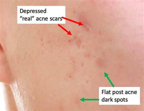 Best Non Surgical Treatment For Acne Scars According To