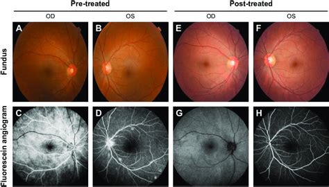 Represents The Color Fundus Photo And Fundus Fluorescein Angiography Of