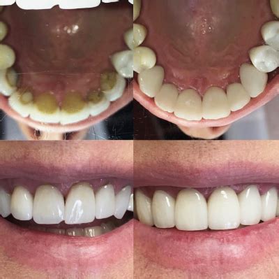 Are veneers or teeth whitening covered under bupa or comparable insurance? Smiles Gallery - Gilbert Dentist | Premier Family Dental
