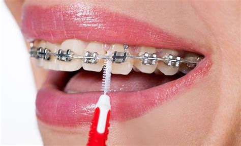 Care And Maintenance Of Braces Columbus Ohio Orthodontics