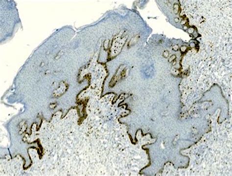 Pathology Outlines Melanotic Macule