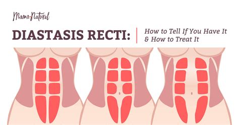 Diastasis Recti Do You Have It Plus How To Treat It