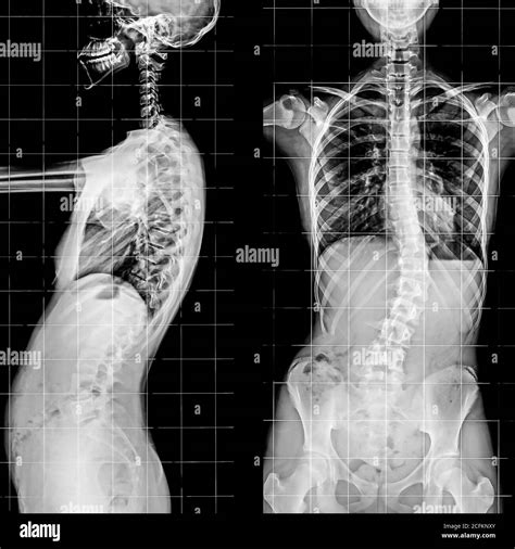 Radiografía De La Columna Vertebral Y Pelvis Del Esqueleto Humano