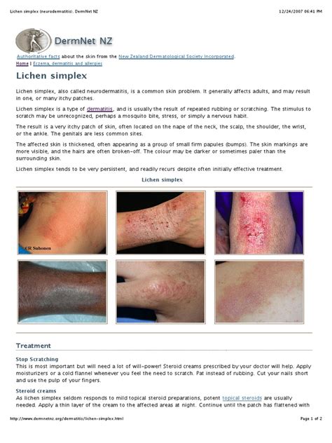 Lichen Simplex Neurodermatitis Dermatitis Dermatology