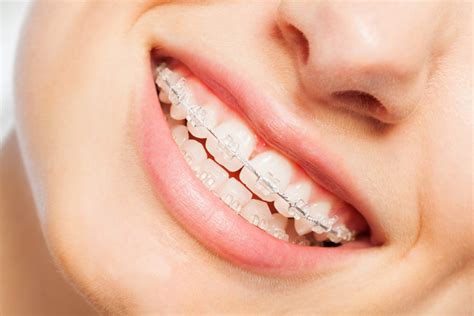 Orthodontics Langdon, AB | Langdon Dental | Damon Braces
