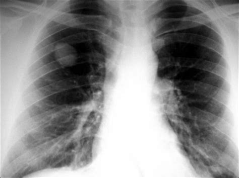 Chest X Ray Of A Patient With Solitary Pulmonary Nodule Download