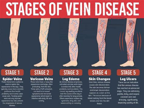Venous Disease Its More Than Just Varicose Veins • Southwest Floridas