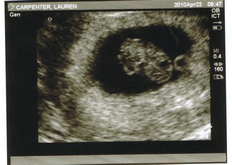 Baby Swanpenter 8 Weeks 3 Days Ultrasound