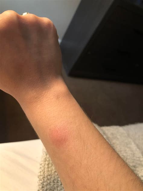 25f Red Bump Appeared On Arm Today Its A Little Painful And Is