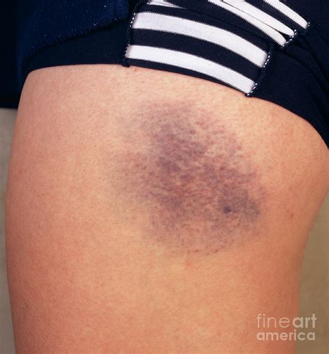 Bruised Leg Photograph By Cordelia Molloyscience Photo Library Fine