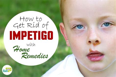 Impetigo Is A Common Skin Infection Usually Occurring As Red Sores On