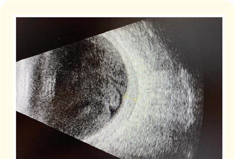 Ocular Ultrasound Of The Right Eye Showing Dense Vitreous Opacities