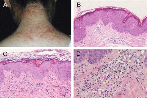 Histopathology Of Persistent Papules And Plaques In Adult Onset Stills