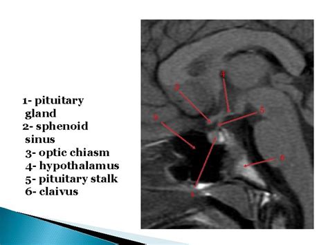 Radiology Anatomy Of The Pituitary Gland Dr Fahad