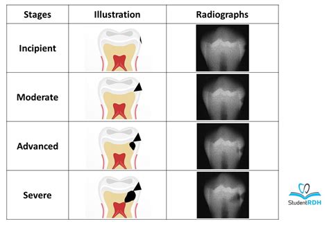 Must Know Classifications Of Dental Caries For The National Dental