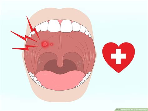 Blood Blisters Inside Of Lip