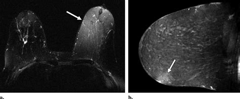 Inhomogeneous Fat Saturation A Axial T1 Weighted Mr Image 42