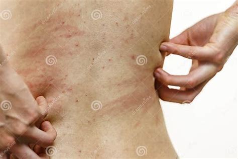 Woman Scratching Her Itchy Back With Allergy Rash Stock Image Image