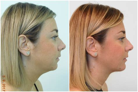 Chin Augmentation Before And After Treatment Las Vegas And Henderson Nv
