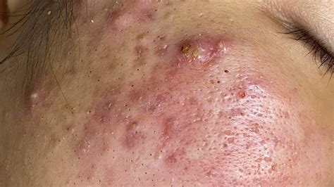 Blackheads Removal In A Teenager With Acne Loan Nguyen Spa April 7