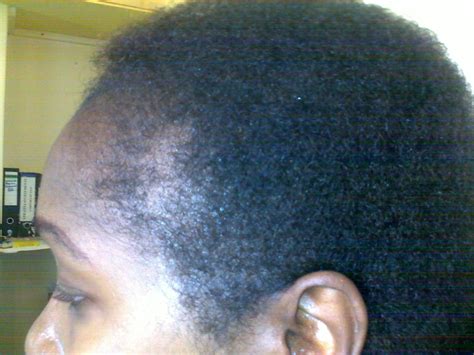 Keep hair extension away from the hairline. Growing black hair to great lengths: Save your hairline!!!