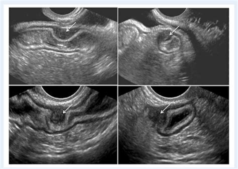 Transvaginal Ultrasound Showing A Hypoechoic Lesion Suggesting Download Scientific Diagram