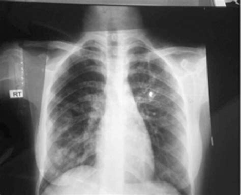Chest X Ray Of The Same 17 Year Old Female With Active Tb Due To