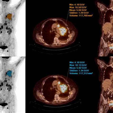 Mip Fused Axial And Coronal Petct Images From Left To Right With 75