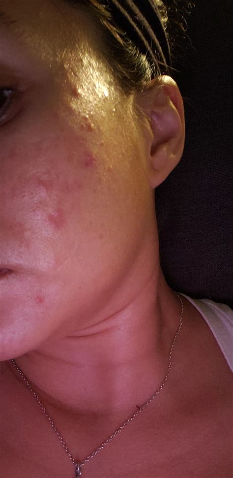 Acne Does This Look Like It Could Be Fungal Skincareaddiction
