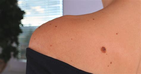 If you have one, here's what to know. Nevus: Definition, Common Types, Photos, Diagnosis, and ...