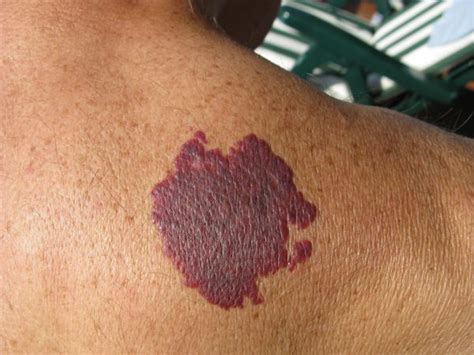 When To Consider Birthmark Removal Forefront Dermatology