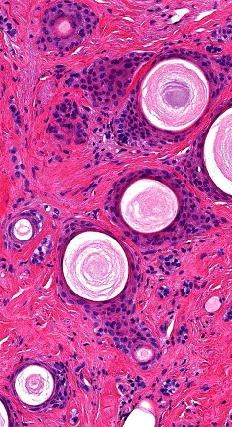 Pathology Of Microcystic Adnexal Carcinoma Ilustraciones Florales