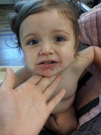I also develop a rash around my cheeks ears bridge of nose, and down the line of my trachea, as well as chest area sometimes when i eat. Bright red rash around mouth????? PIC ADDED - BabyCenter