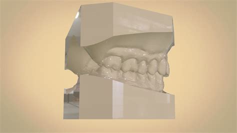 Digital Orthodontic Study Models With Virtual Abo Bases 3d Model 3d