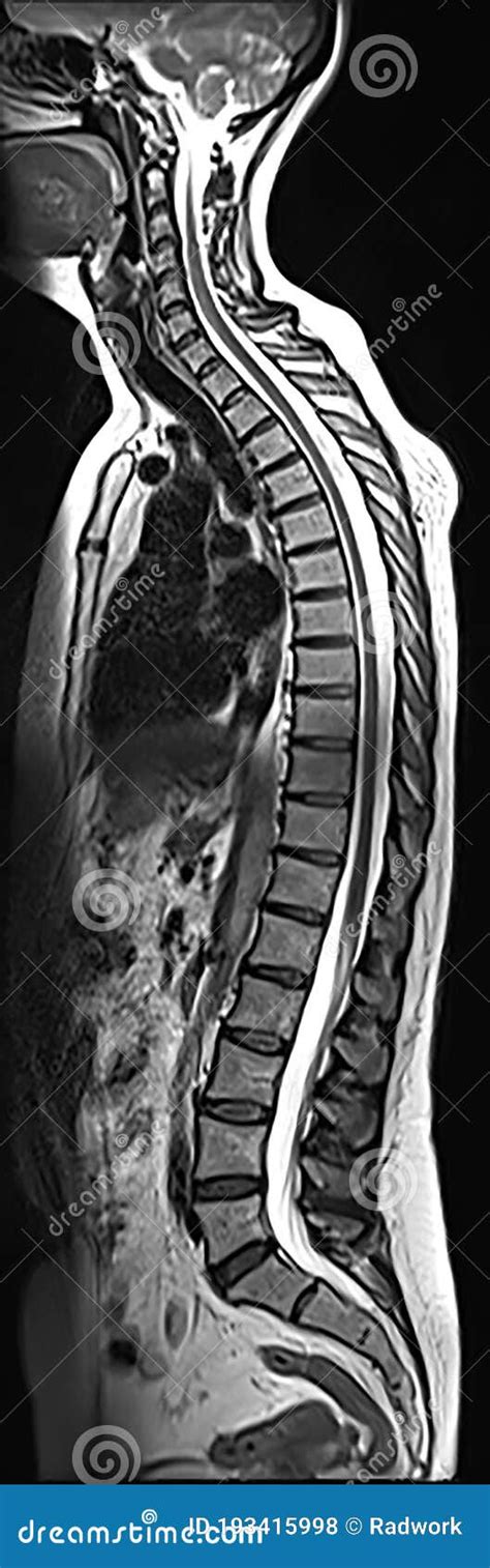 Whole Spine Mri Stock Photo Image Of Resonance Body 193415998