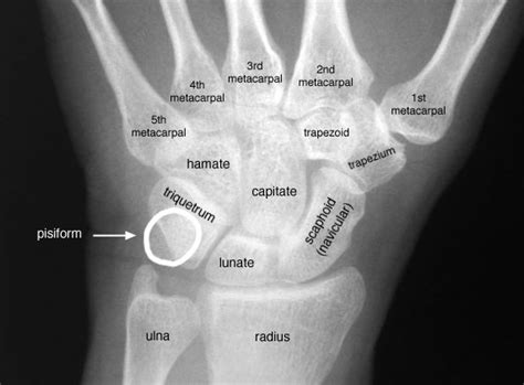 Radiographic Anatomy Of The Skeleton Wrist Posteroterior Pa View