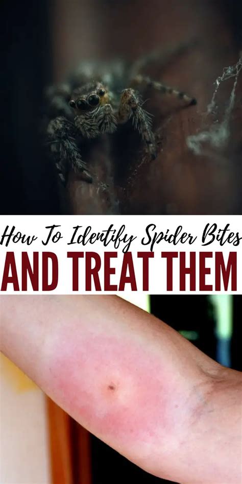 How To Treat Spider Bites Images And Photos Finder