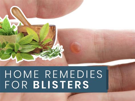 21 Home Remedies For Blisters On Tongue Lips Face And Feet