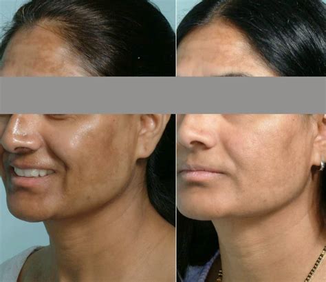 Aura Skin Clinic Visakhapatnam Pigmentation Freckles Melasma