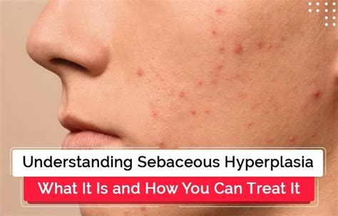 Understanding Sebaceous Hyperplasia Causes And Treatment Ws