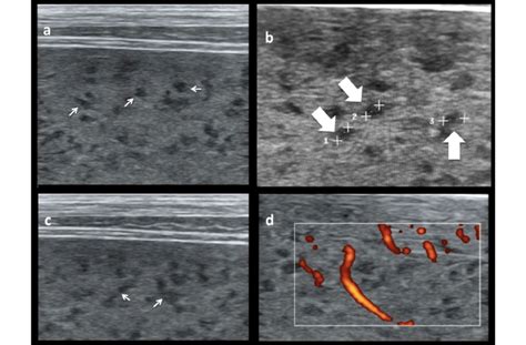 Sonographic Appearance Of The Spleen Of Index Patient A Numerous Tiny