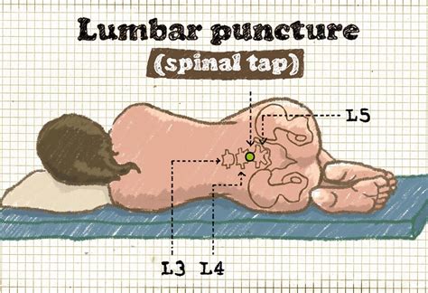Lumbar Puncture In Children Procedure Benefits And Risks