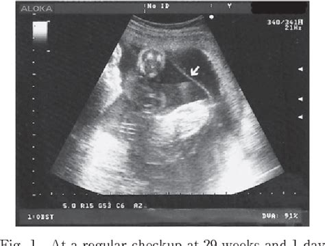Figure 1 From A Case Report Of Complete Chorioamniotic Membrane