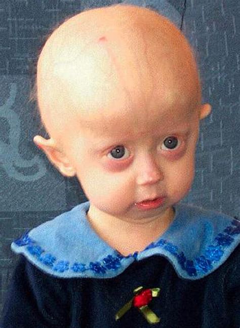 Cancer Drug May Be The First Treatment For Progeria