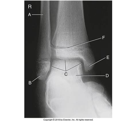Ap Mortise X Ray Ankle Labeling Diagram Quizlet