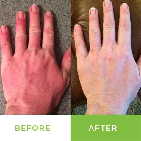 68 Best Images About Metaderm Psoriasis Relief On Pinterest Health