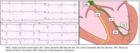 Bloqueo De Rama Alternante Taquicardia Dependiente En Cardiopatía