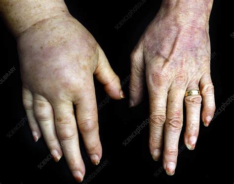 Lymphoedema In Breast Cancer Stock Image C0238941 Science Photo