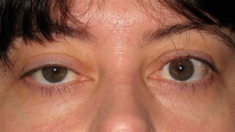 Ptosis Or Droopy Eyelid Causes And Treatments Step To Health